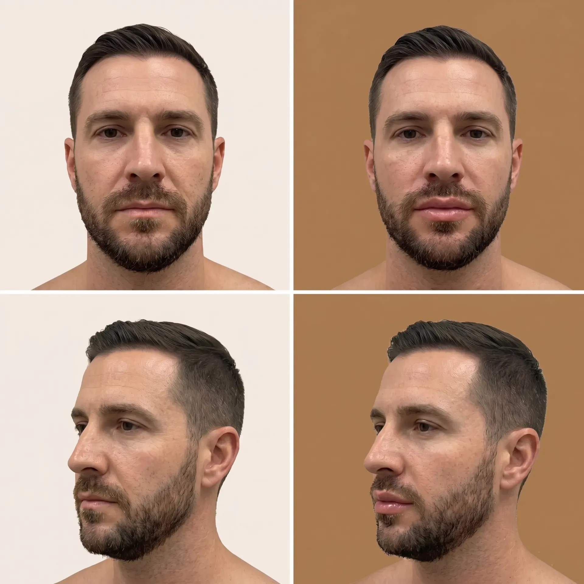 Lip Lift — before and after